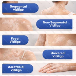 Healrize® Piperine Vitiligo Repigmentation Spray