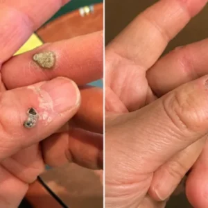 Zerowrink® 2-in-1 Microneedle & Hydrocolloid Patch