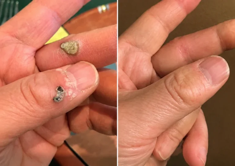 Zerowrink® 2-in-1 Microneedle & Hydrocolloid Patch